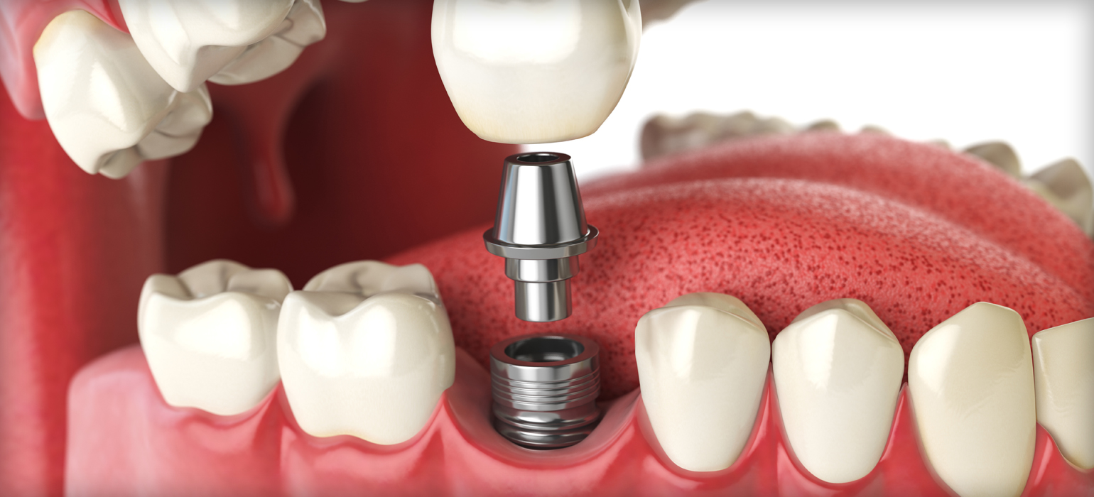 ourservices_implants Implant image