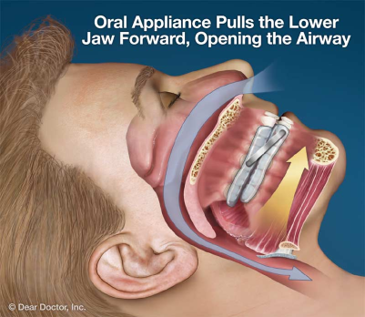 Oral Appliace Therapy Compressed
